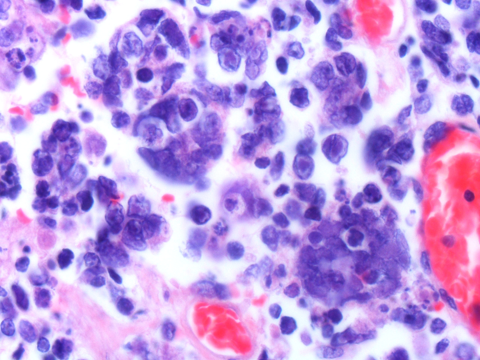 The Connection Between Carcinoma and Viral Infections
